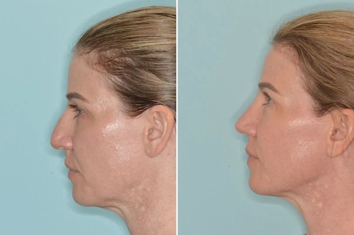 Rhinoplasty before and after, lateral left.