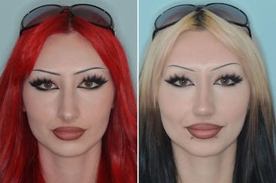 Rhinoplasty before and after, frontal.
