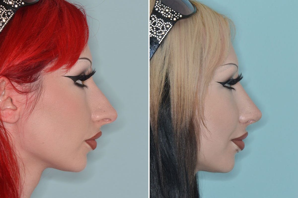 Rhinoplasty before and after, lateral right.
