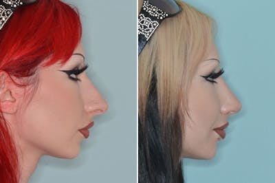 Rhinoplasty before and after, lateral right.