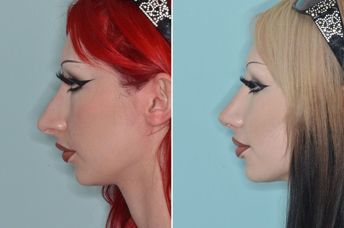 Rhinoplasty before and after, lateral left.