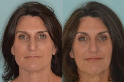 Rhinoplasty before and after, frontal.