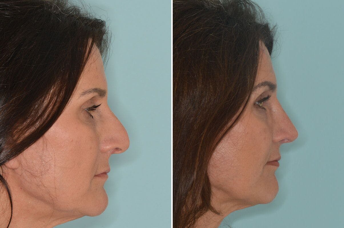 Rhinoplasty before and after, lateral right.