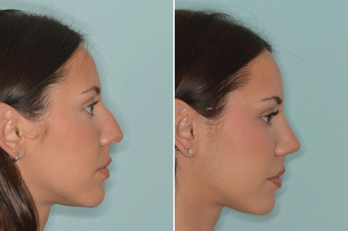 Ethnic Rhinoplasty before and after, lateral right.
