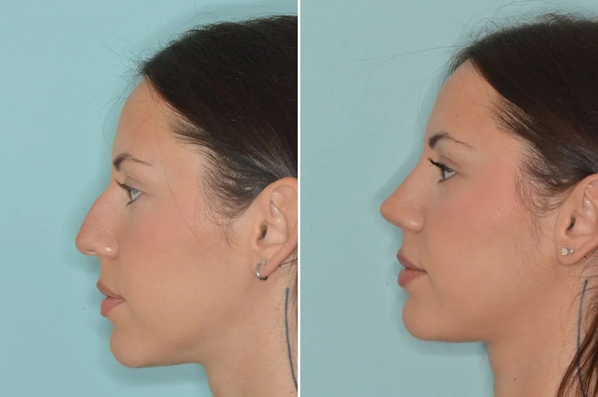 Ethnic Rhinoplasty before and after, lateral left.