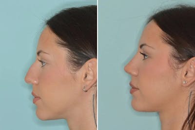 Ethnic Rhinoplasty before and after, lateral left.