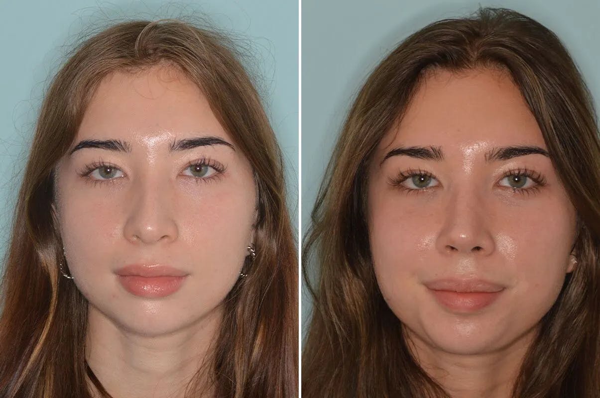 Rhinoplasty before and after, frontal.