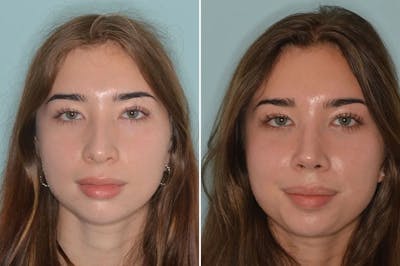 Rhinoplasty before and after, frontal.