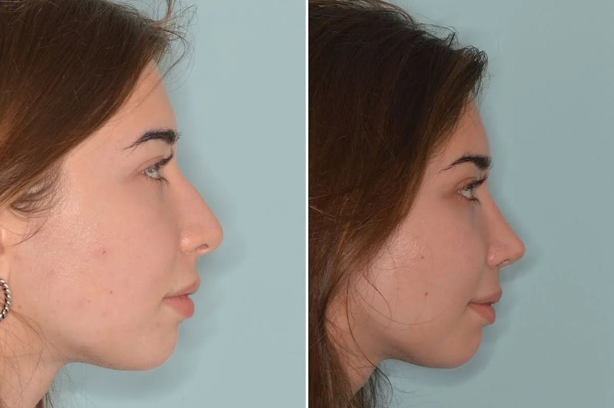 Rhinoplasty before and after, lateral right.