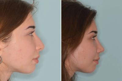 Rhinoplasty before and after, lateral right.