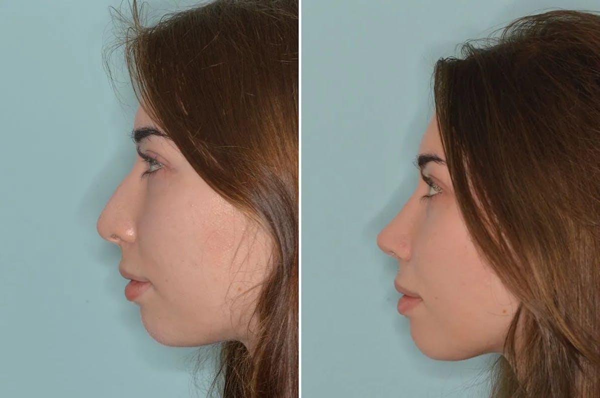 Rhinoplasty before and after, lateral left.