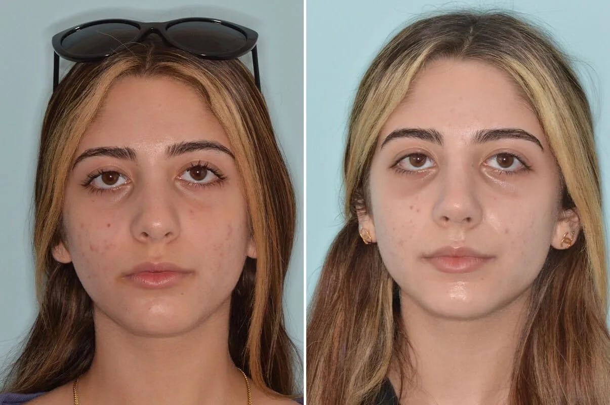 Ethnic Rhinoplasty before and after, frontal.