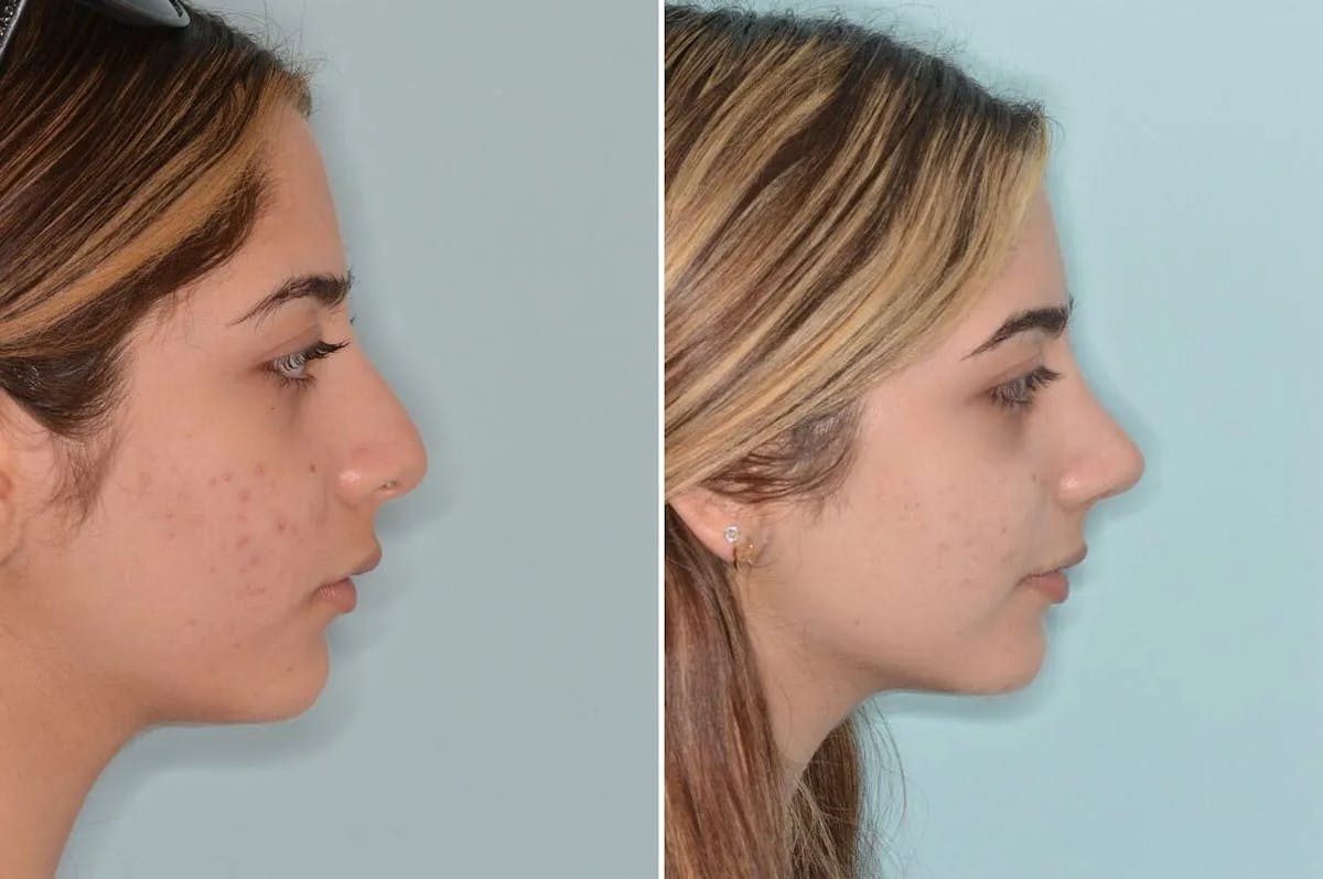 Ethnic Rhinoplasty before and after, lateral right.