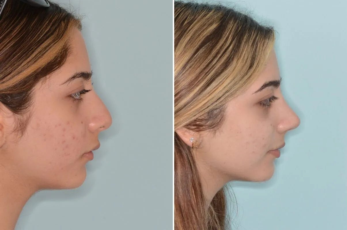 Ethnic Rhinoplasty before and after, lateral right.