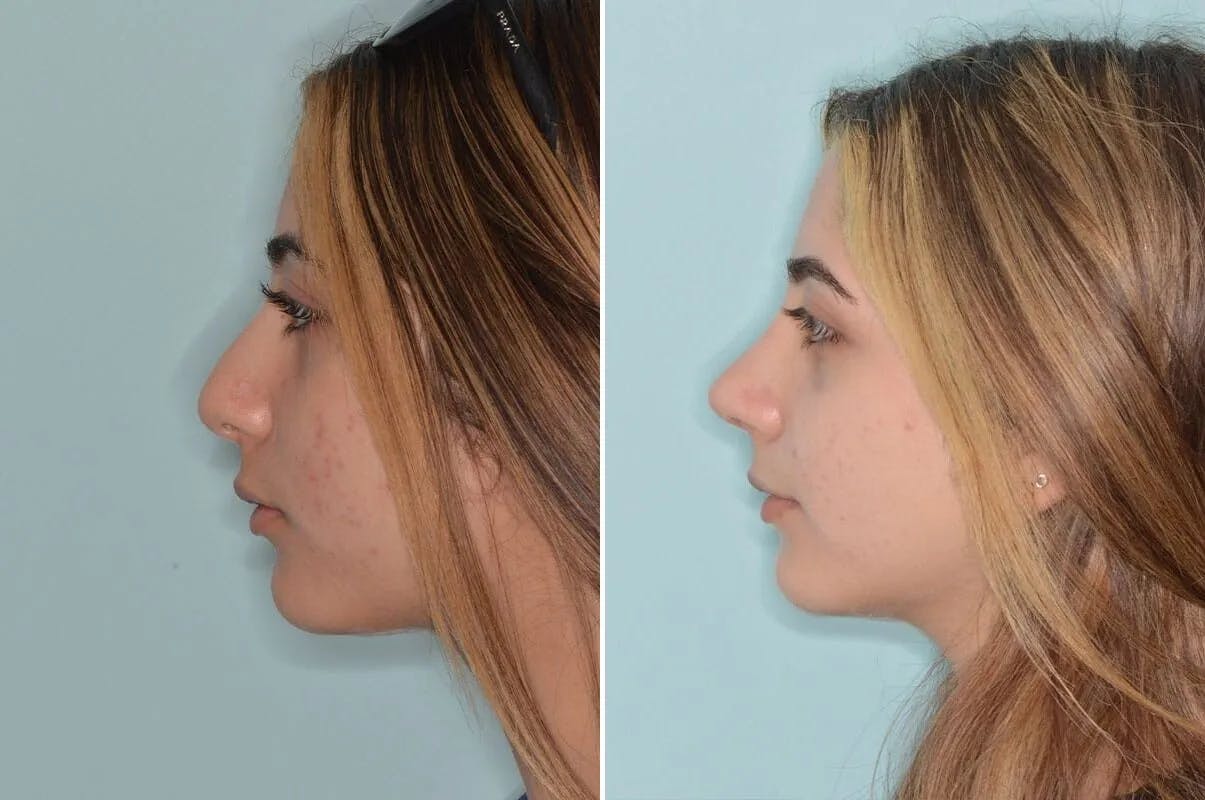 Ethnic Rhinoplasty before and after, lateral left.