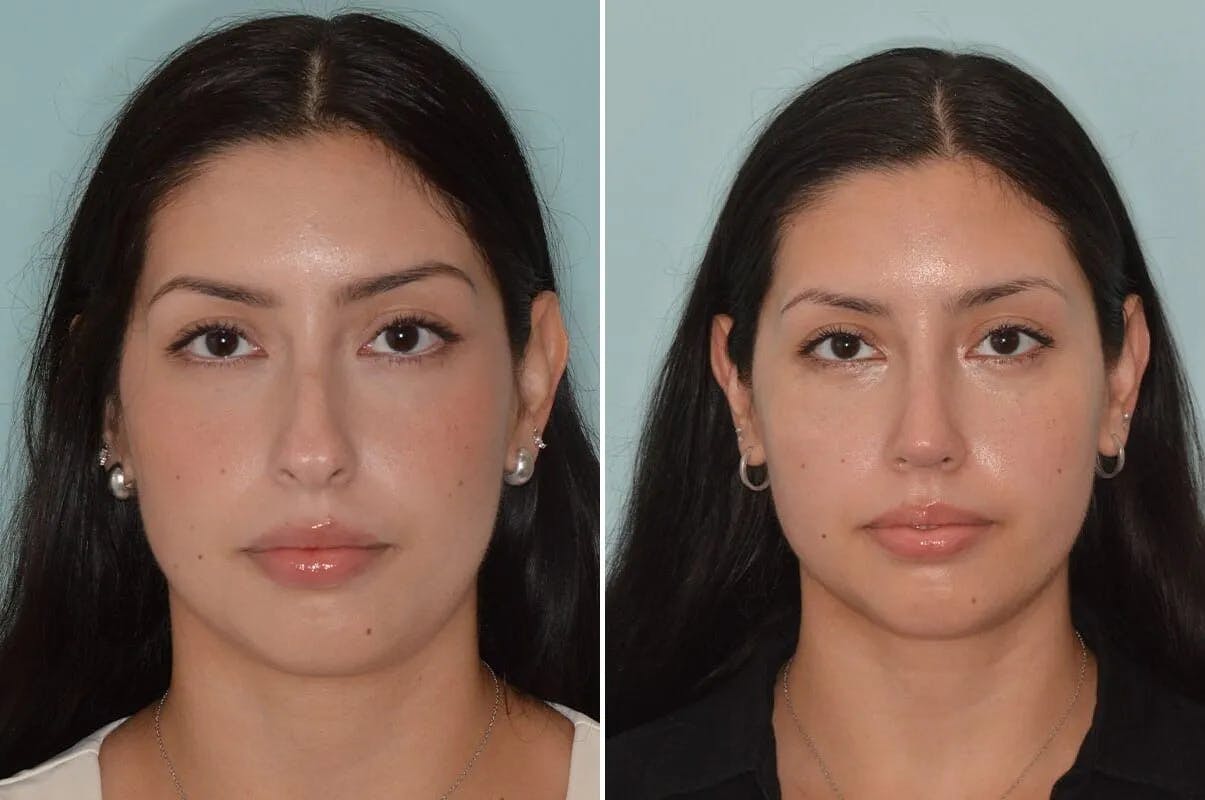 Rhinoplasty before and after, frontal.