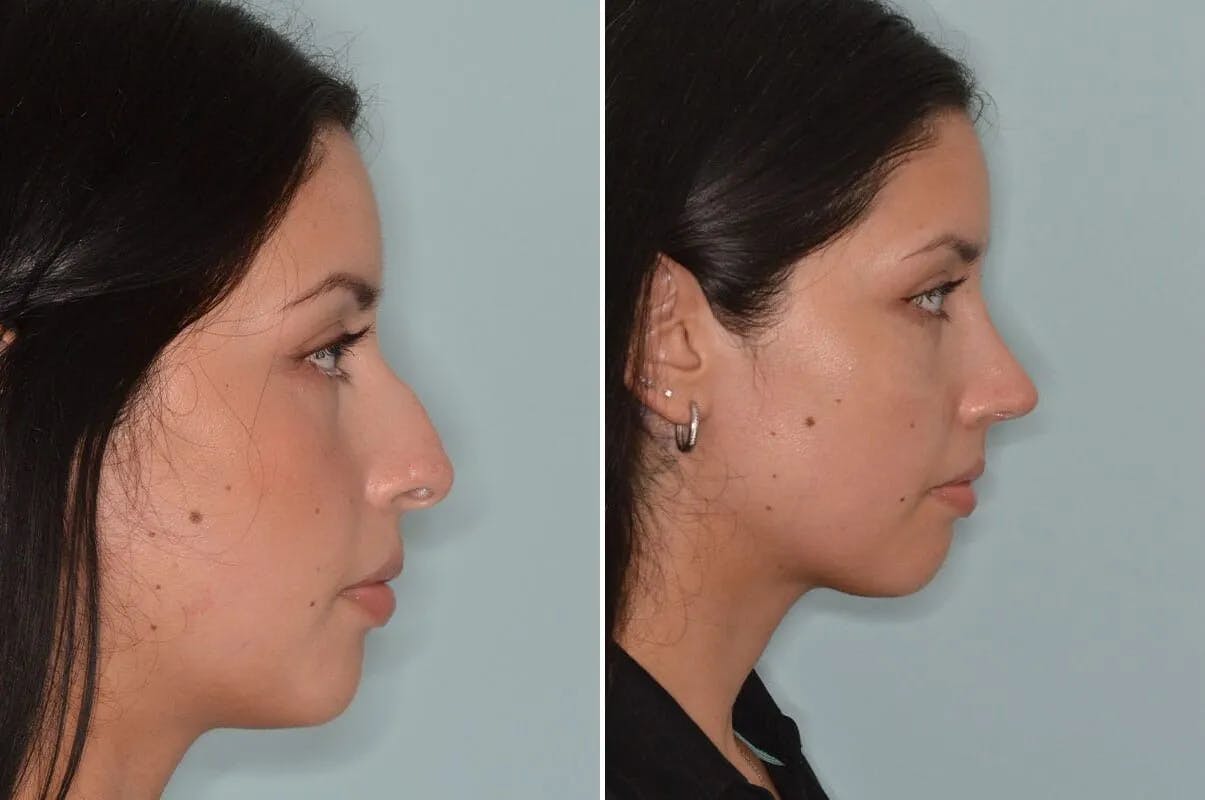 Rhinoplasty before and after, lateral right.