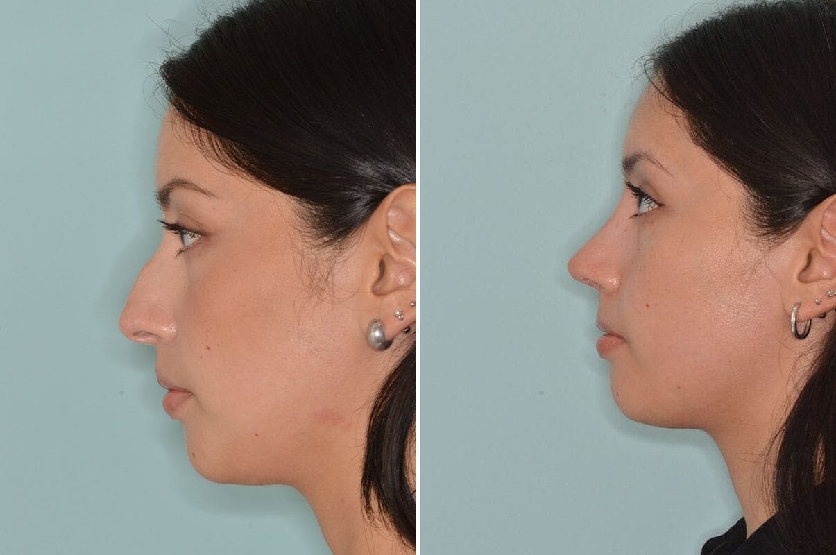 Rhinoplasty before and after, lateral left.