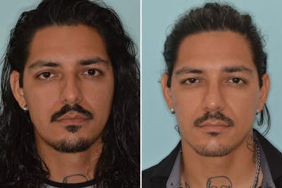 Rhinoplasty before and after, frontal.