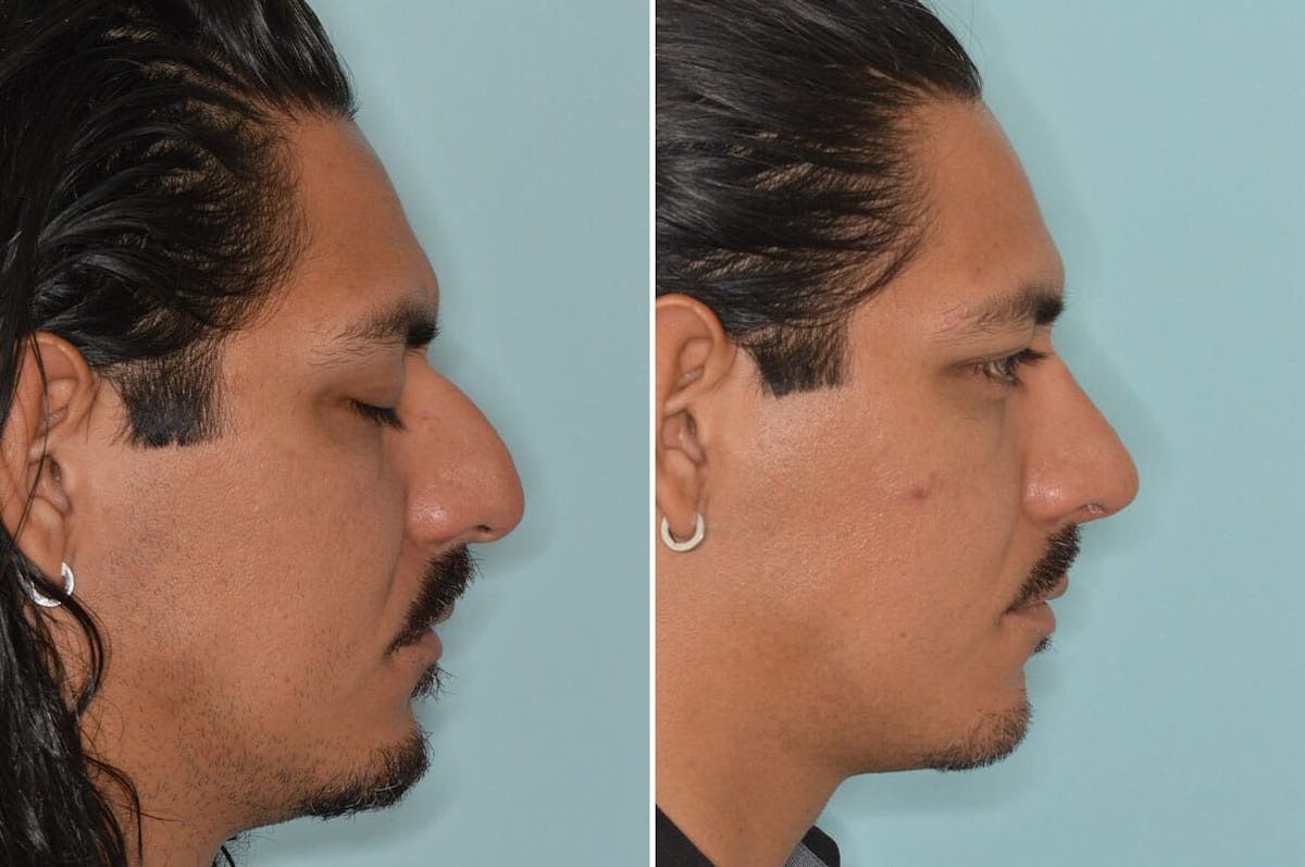 Rhinoplasty before and after, lateral right.