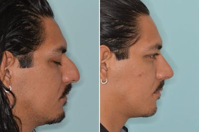 Rhinoplasty before and after, lateral right.