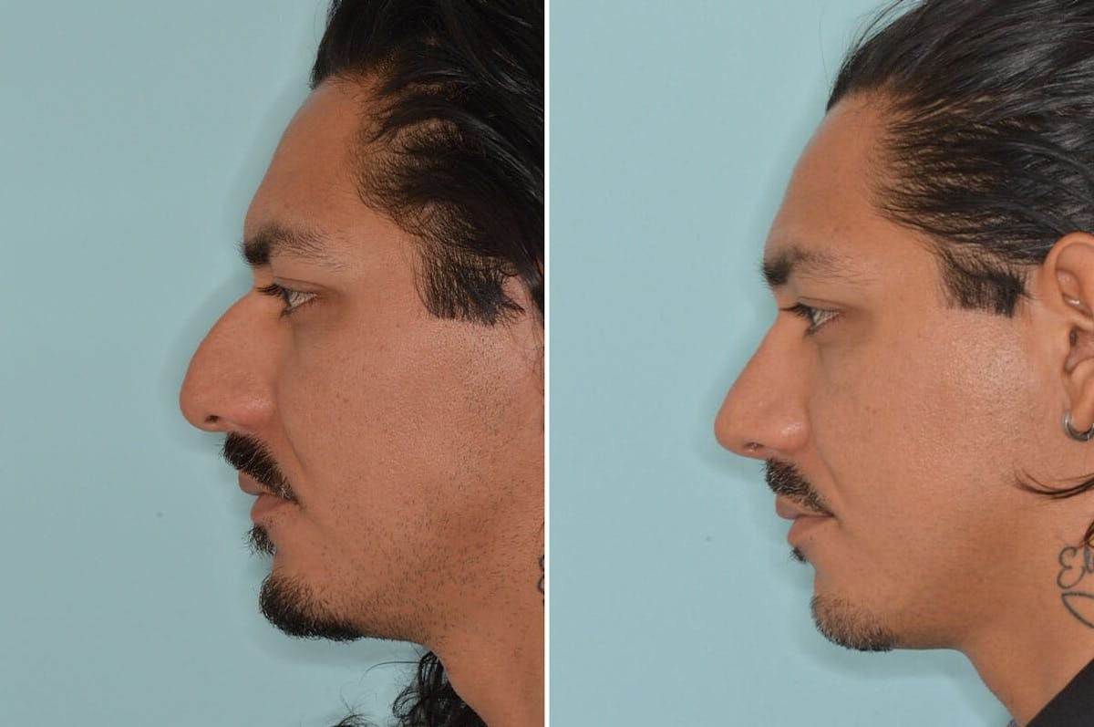 Rhinoplasty before and after, lateral left.