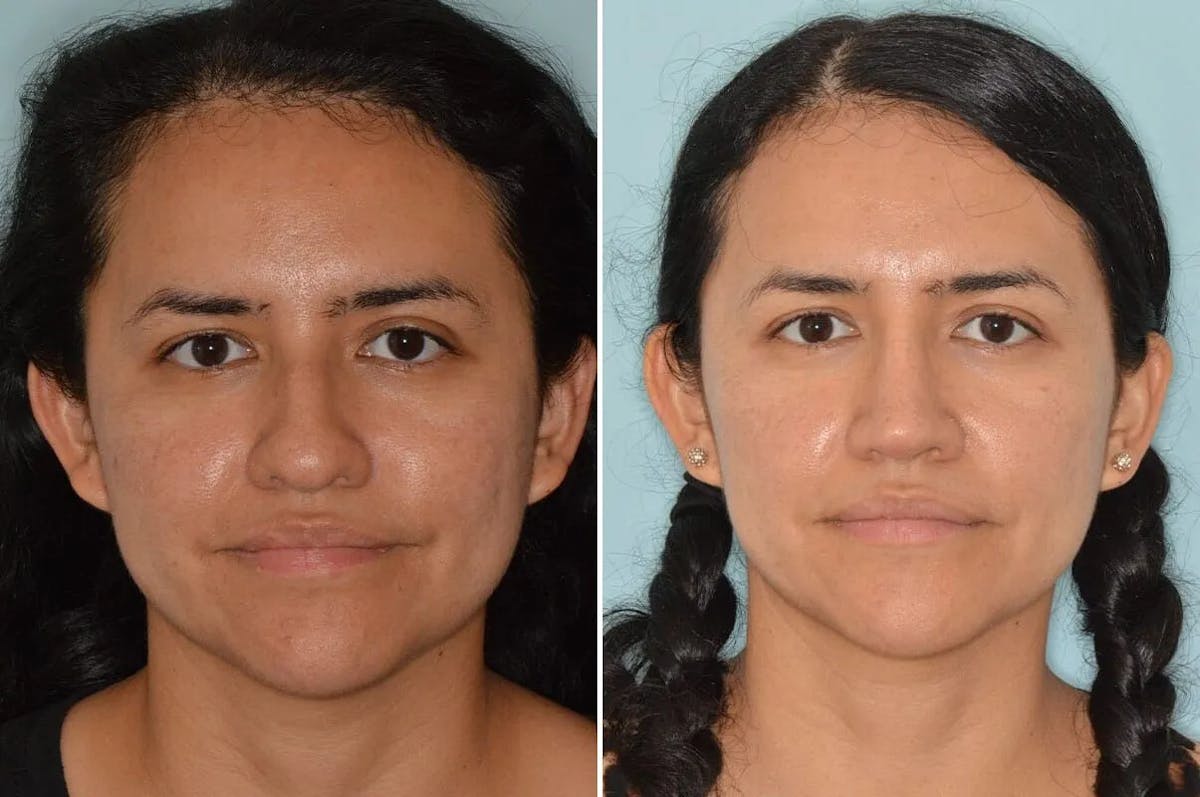 Rhinoplasty before and after, frontal.