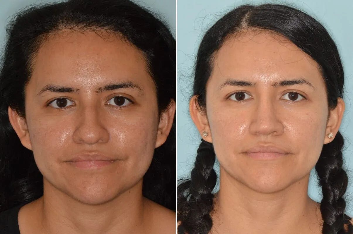 Rhinoplasty before and after, frontal.