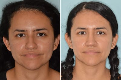 Rhinoplasty before and after, frontal.