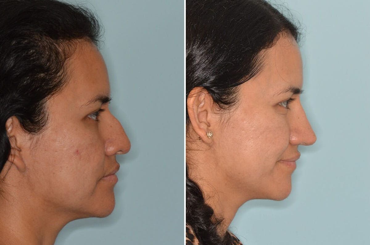 Rhinoplasty before and after, lateral right.
