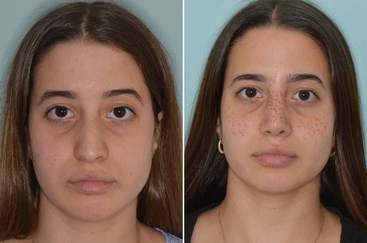Rhinoplasty before and after, frontal.