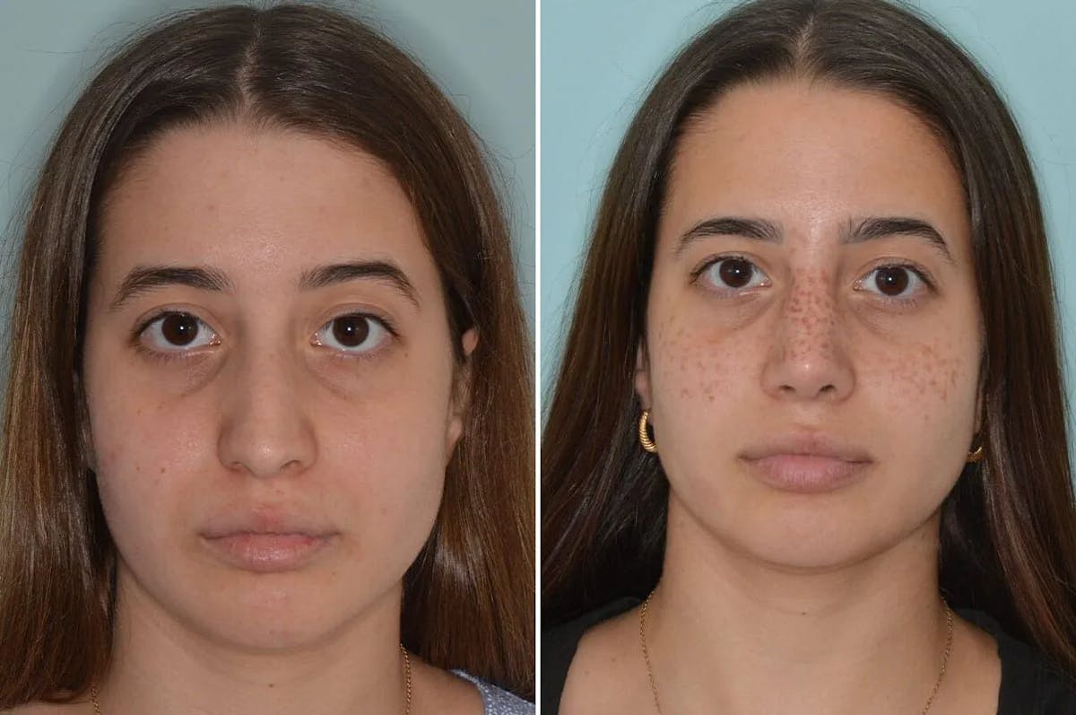 Rhinoplasty before and after, frontal.