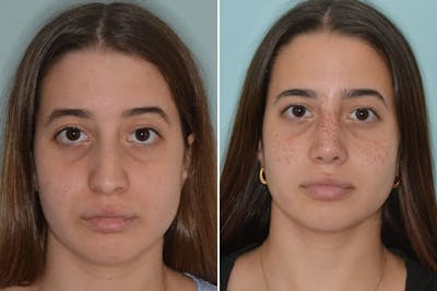 Rhinoplasty before and after, frontal.