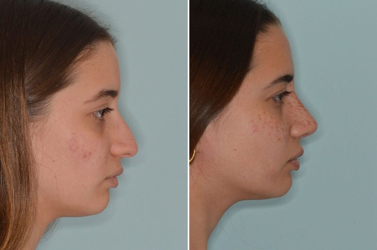 Rhinoplasty before and after, lateral right.