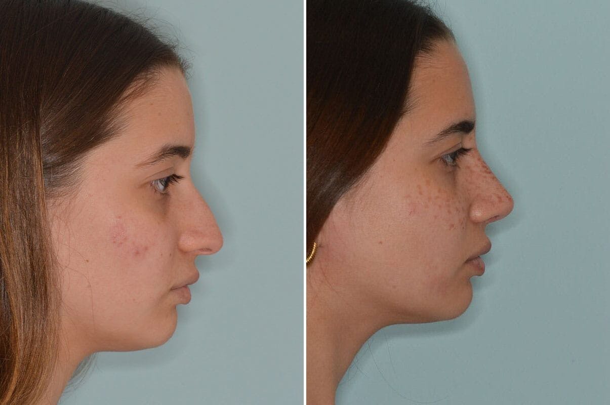 Rhinoplasty before and after, lateral right.