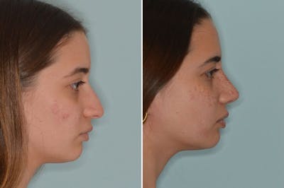 Rhinoplasty before and after, lateral right.
