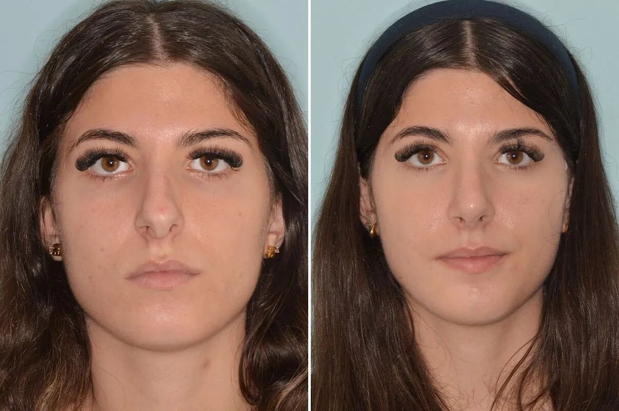 Rhinoplasty before and after, frontal.