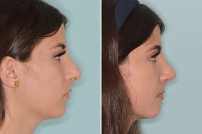 Rhinoplasty before and after, lateral right.