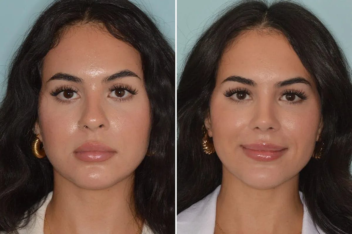 Rhinoplasty before and after, frontal.