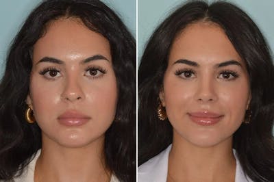 Rhinoplasty before and after, frontal.