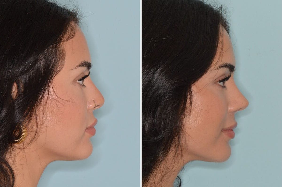 Rhinoplasty before and after, lateral right.