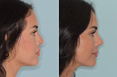 Rhinoplasty before and after, lateral right.
