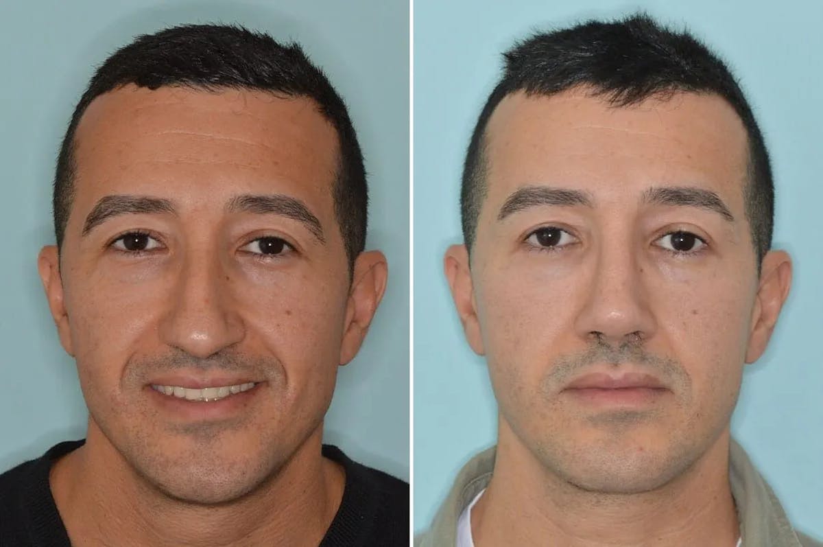 Rhinoplasty before and after, frontal.
