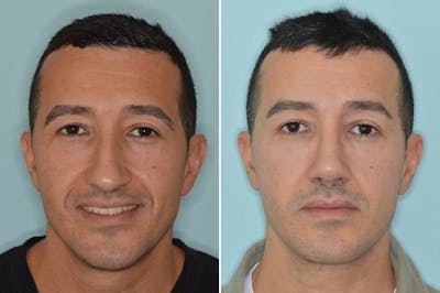Rhinoplasty before and after, frontal.