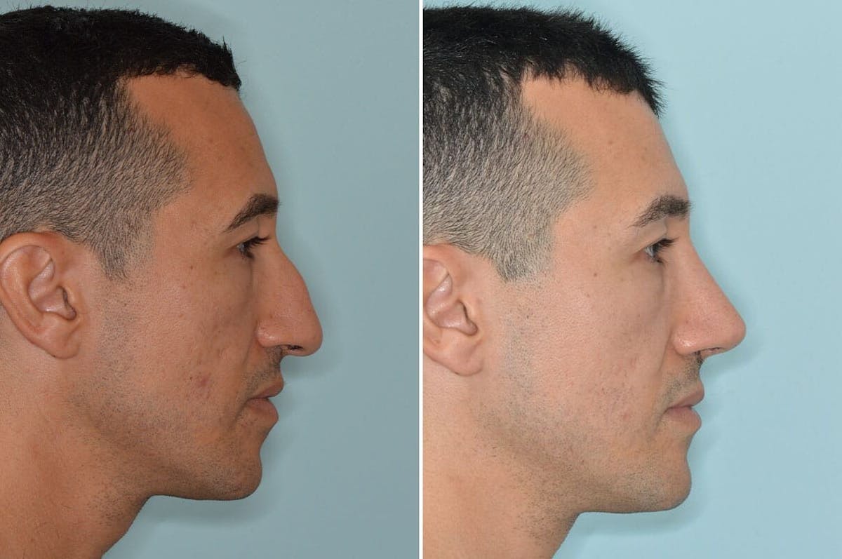 Rhinoplasty before and after, lateral right.