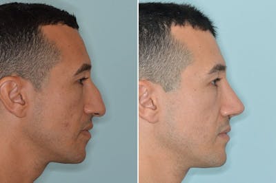 Rhinoplasty before and after, lateral right.