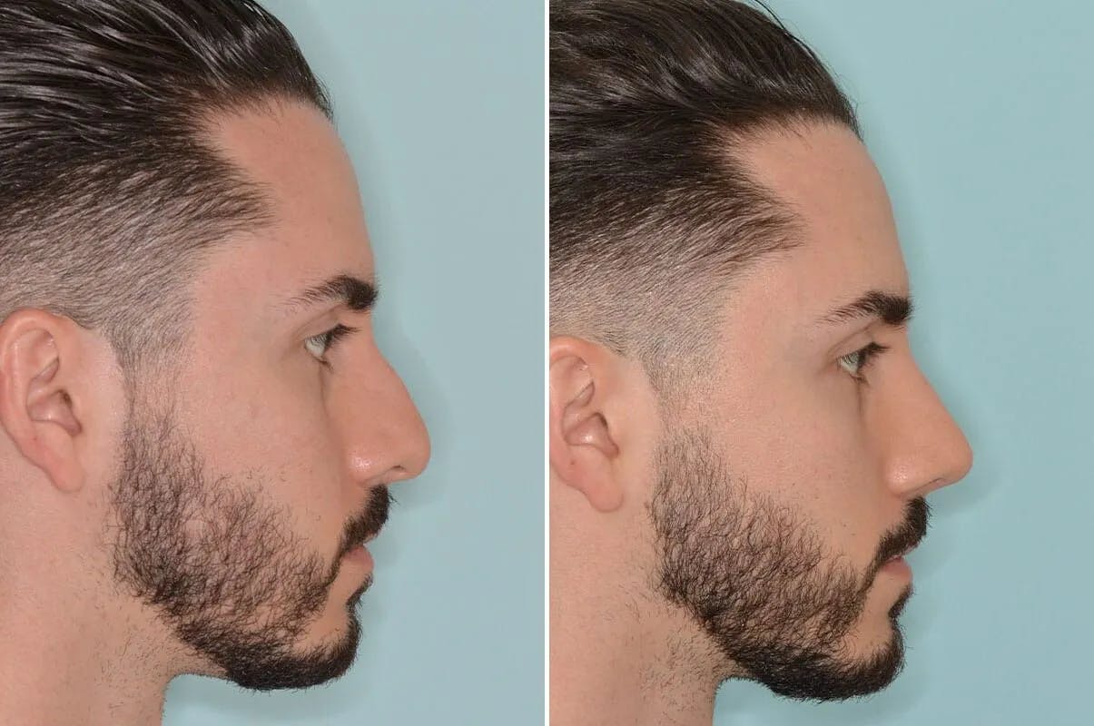 Rhinoplasty before and after, lateral right.