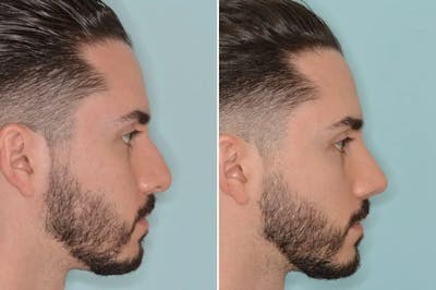 Rhinoplasty before and after, lateral right.
