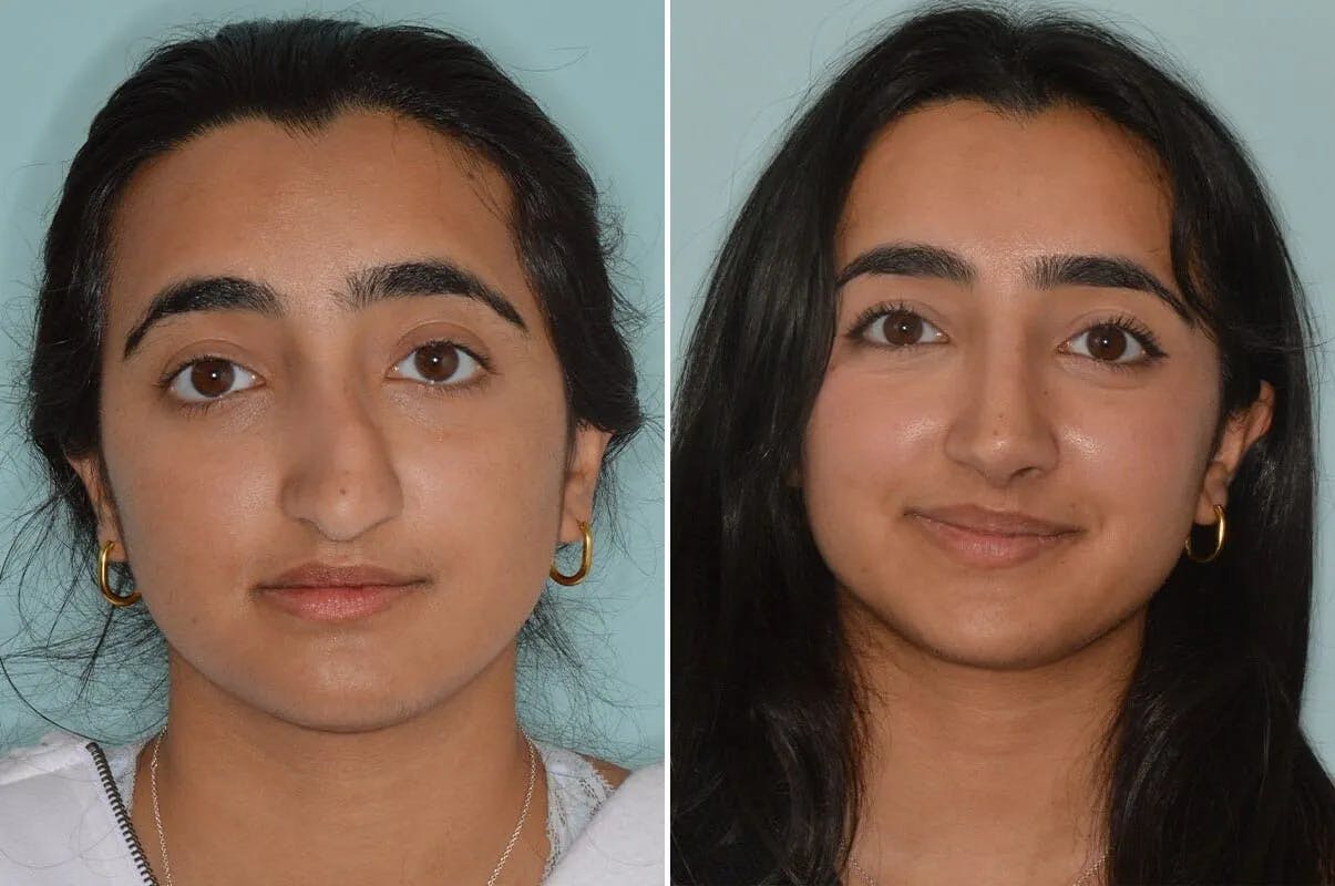 Rhinoplasty before and after, frontal.