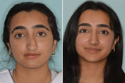Rhinoplasty before and after, frontal.